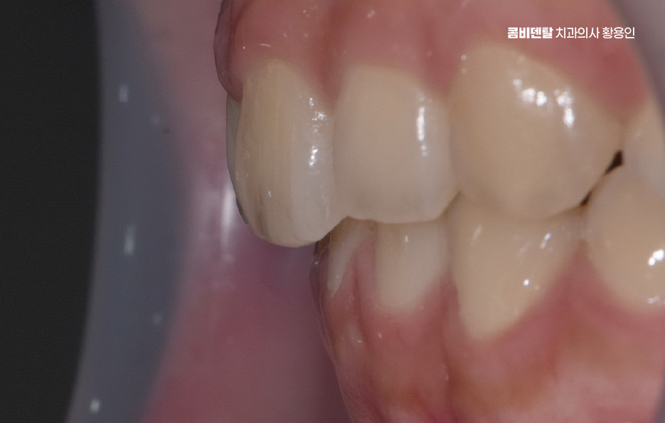 과개교합 교정 후 얼굴형 얼마나 바뀌나요 관련 이미지 5