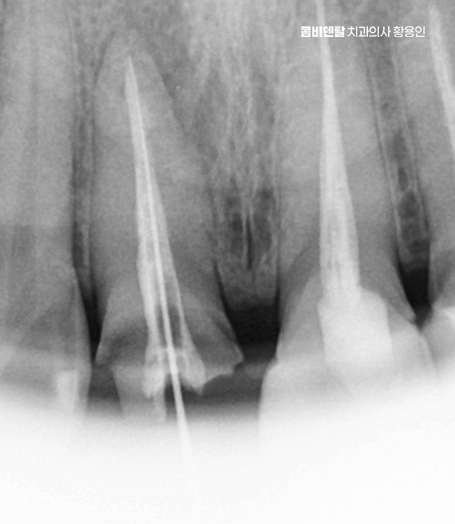 앞니 신경치료 크라운 까지 해야할 상황이라면 관련 이미지 9
