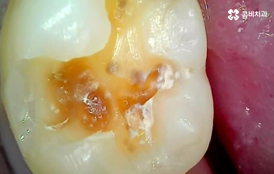 레진 인레이 치료 후 2차충치 왜 발생하고 어떻게 대처할까 관련 이미지 10
