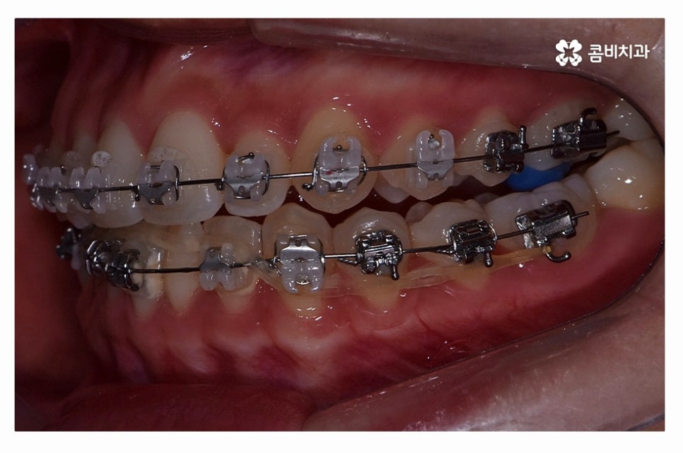 덧니교정 체계적으로 준비하려면 관련 이미지 10