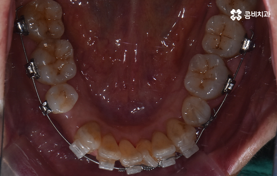 돌출입 콤비교정으로 얼굴까지 개선하는 방법은 관련 이미지 11