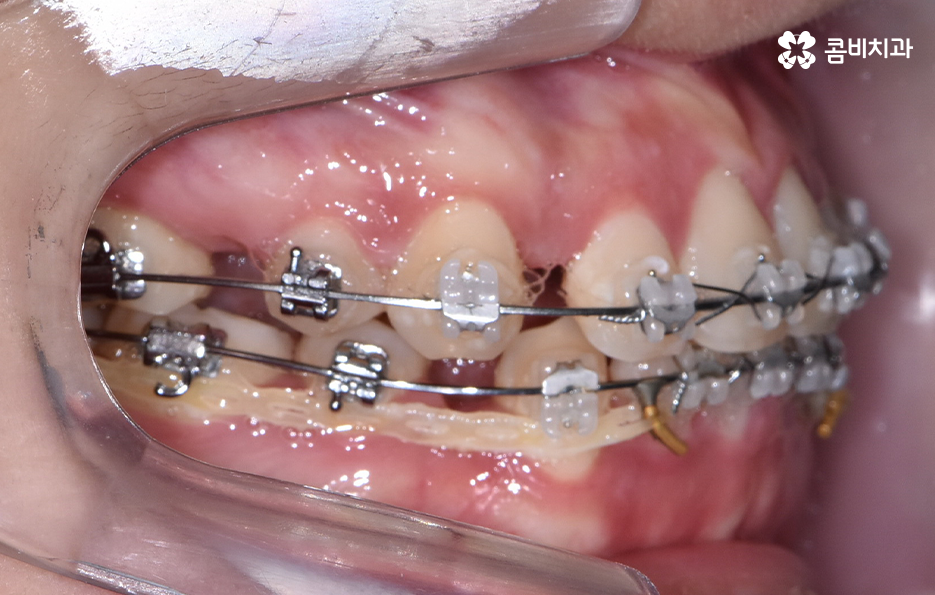 돌출입발치교정 기대해봐도 될까요 관련 이미지 9