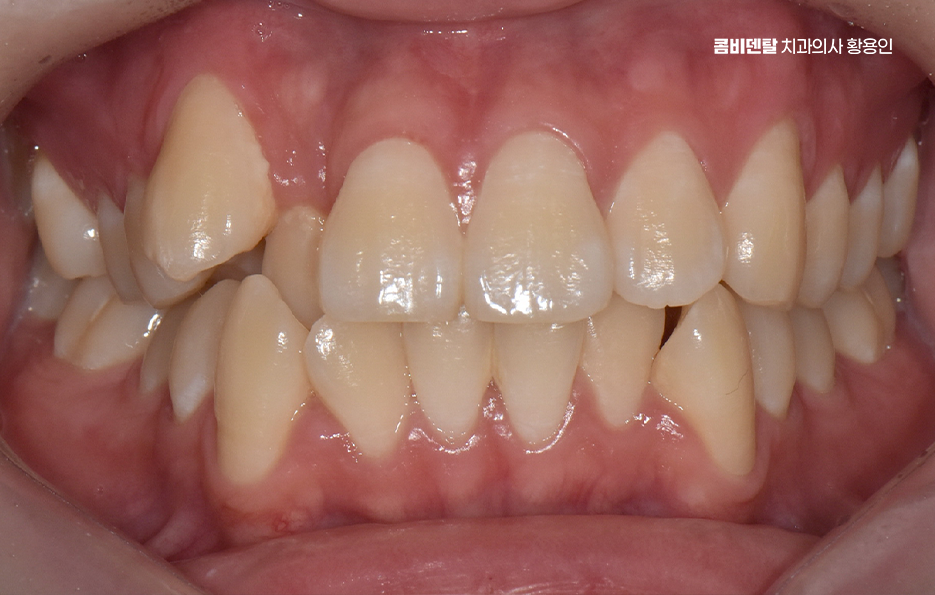 송곳니 덧니 발치 이럴때 해당되네요 관련 이미지 2