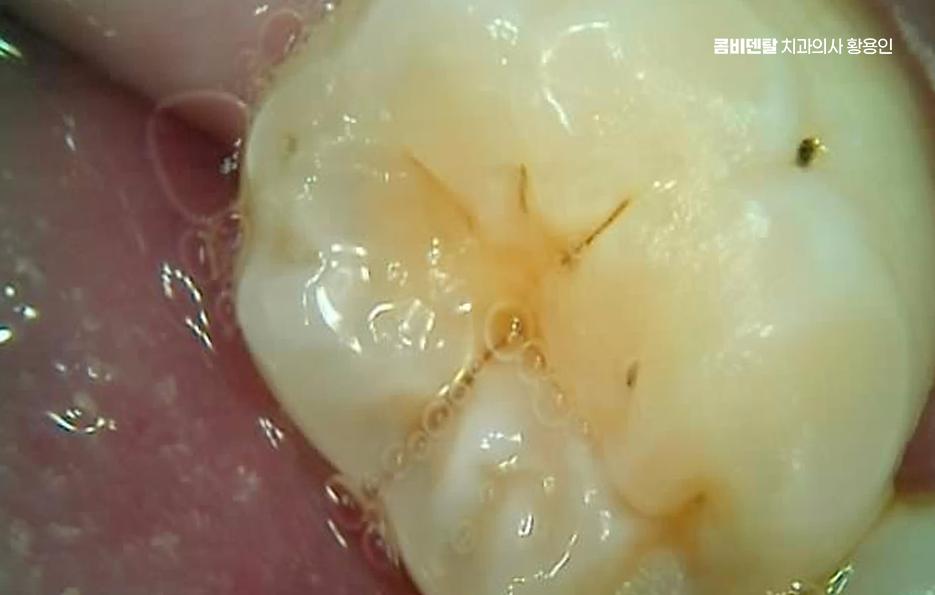 충치 검은점 나타났다면 이렇게 대처해요 관련 이미지 8