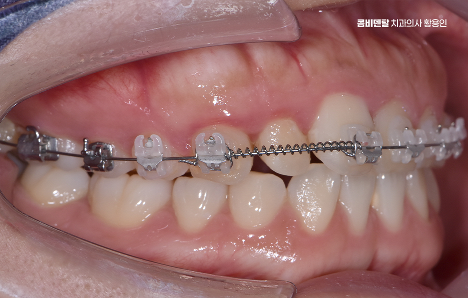치아교정 통증 줄이는 방법 어떻게 가능할까요 관련 이미지 7