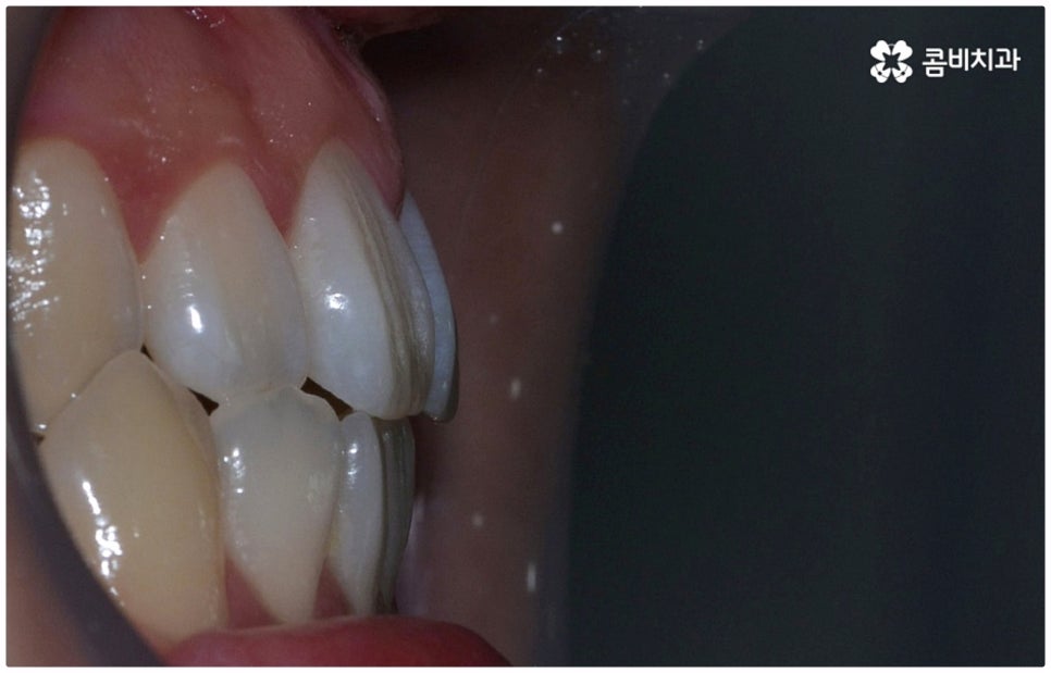 부정교합 3급 왜 고쳐야 하나요 관련 이미지 3