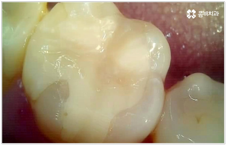충치 인레이 언제 받나요? 관련 이미지 8