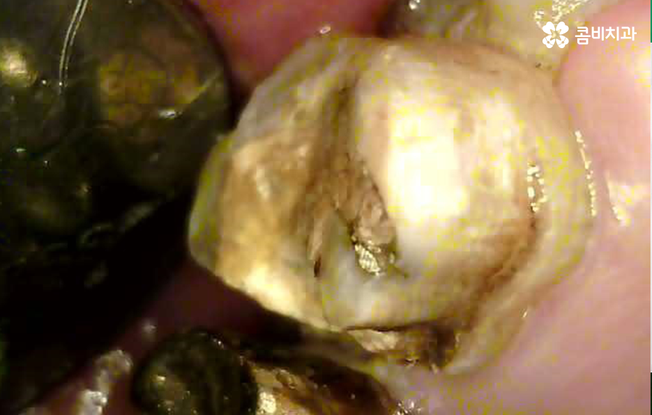 어금니 충치 발치 결국 뽑아야 할때와 살릴 수 있는 케이스 관련 이미지 12
