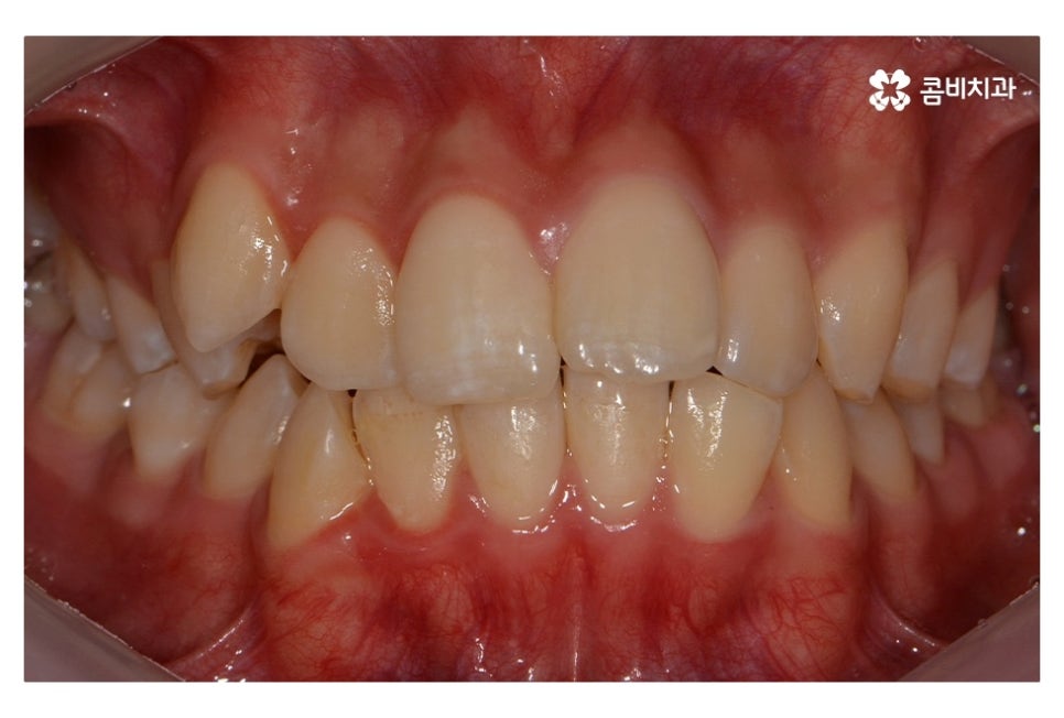 중학생치아교정 세심하게 체크하려면 관련 이미지 1