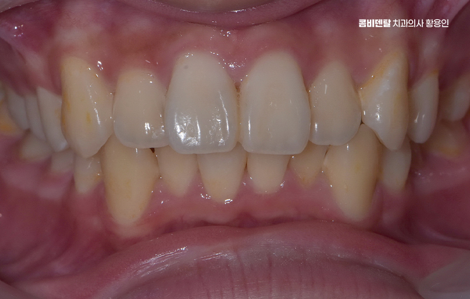 부정교합 교정 안하면 생기는 문제는 뭔가요 관련 이미지 1