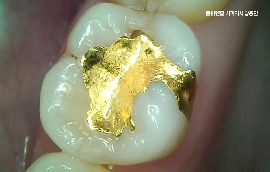 인레이 치료 후 통증 자꾸 심해지는데 괜찮은걸까 관련 이미지 3