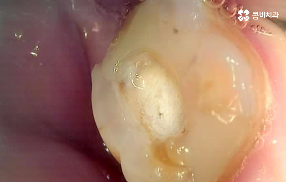 충치 단계 어떻게 분류하고 치료해야 하나요 관련 이미지 7