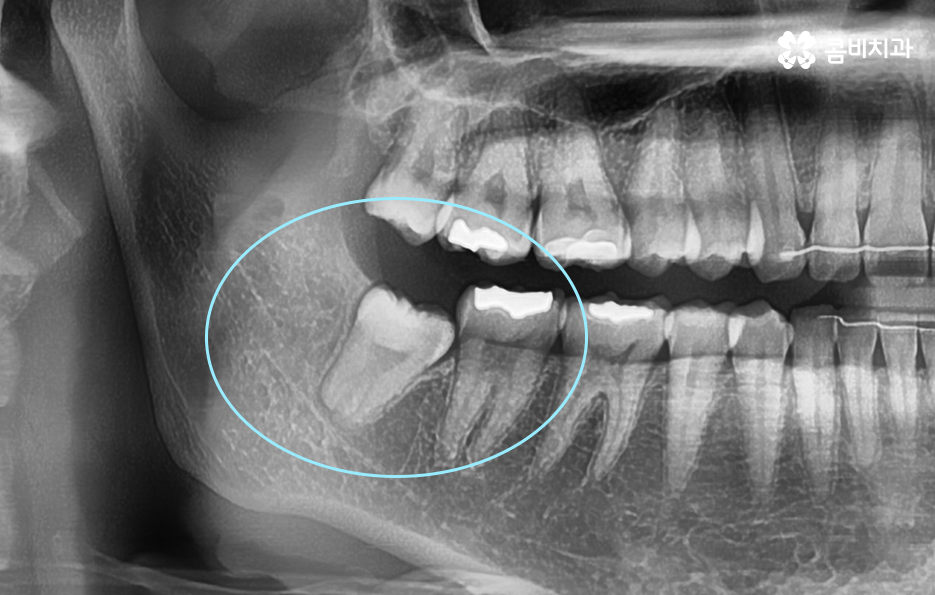 매복사랑니 냄새 방치하면 이런 문제도 생겨요 관련 이미지 2