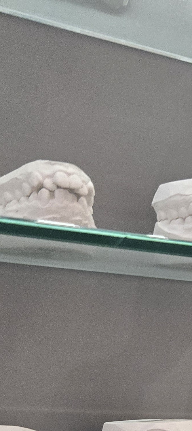 앞니 틀어짐 교정 이렇게 파악하세요 관련 이미지 12