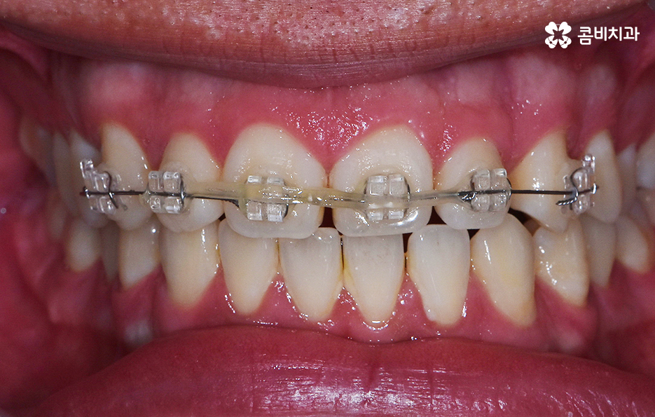 치아부분교정 내게도 적합한지 알아보려면 관련 이미지 6