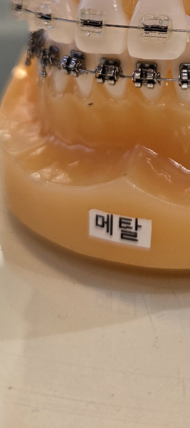 송곳니 덧니 발치 이럴때 해당되네요 관련 이미지 20