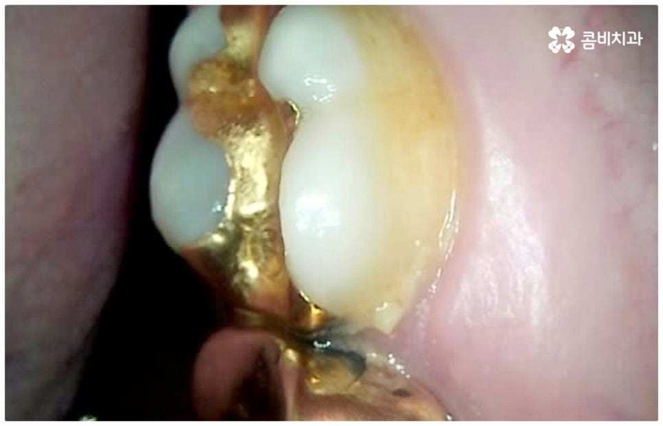 어금니충치치료 아프다면 빨리 관련 이미지 7