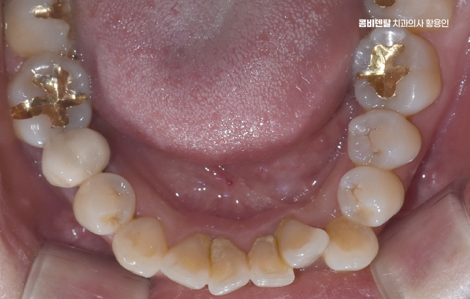 앞니 틀어짐 교정 조화롭게 마무리하려면 관련 이미지 6