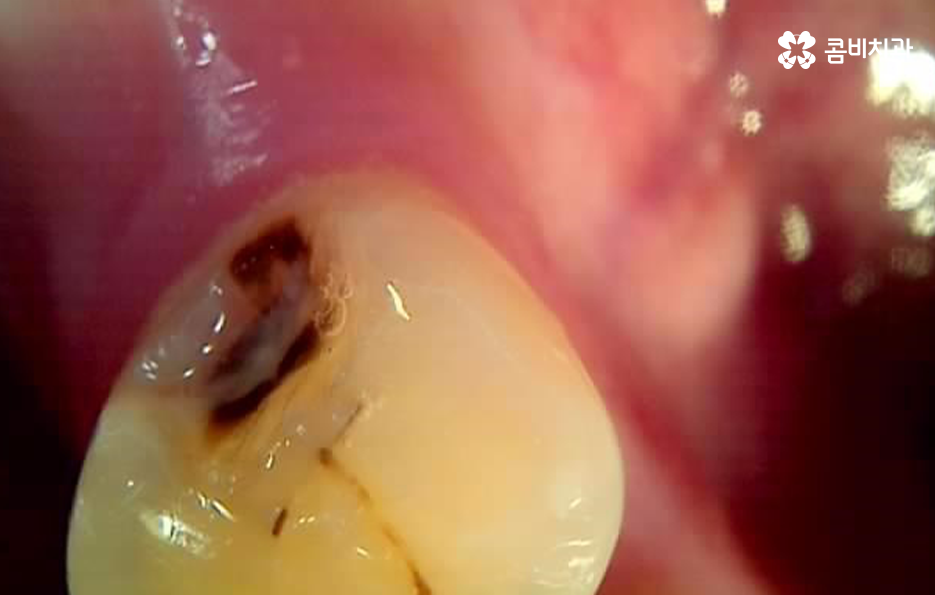 충치 단계 어떻게 분류하고 치료해야 하나요 관련 이미지 6