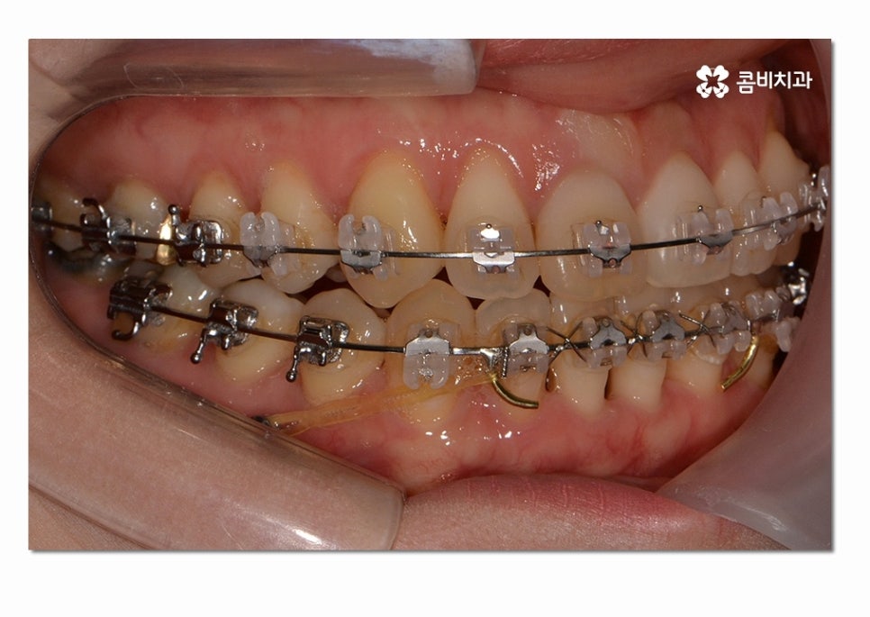 3급 부정교합 지금이라도 고치고 싶다면 관련 이미지 10