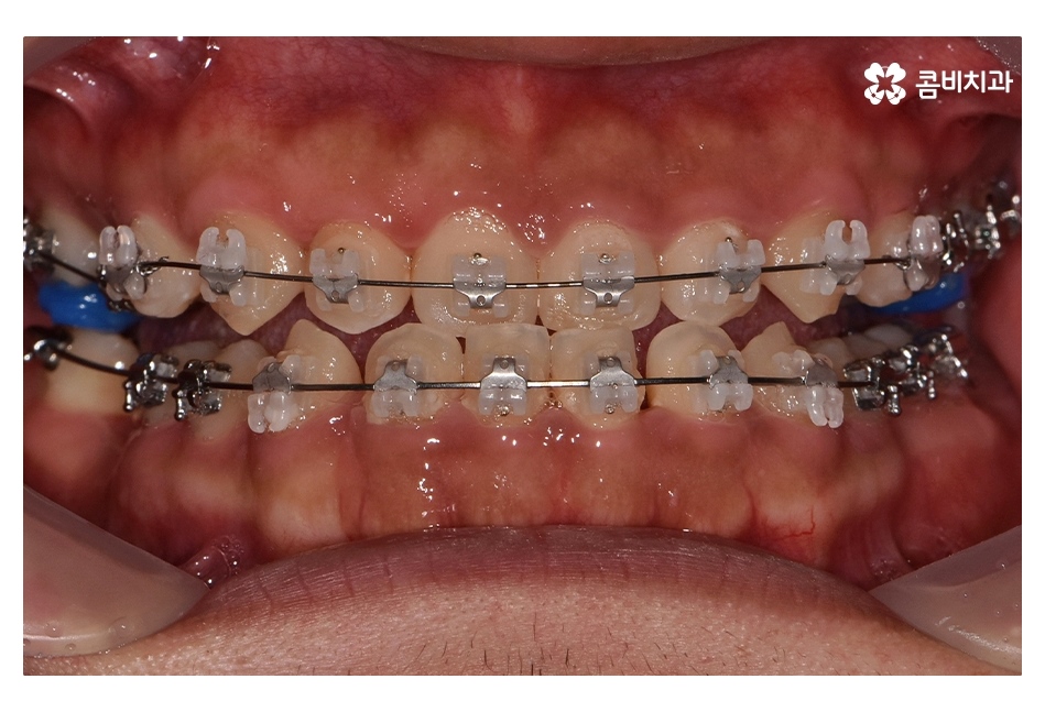 클리피씨교정 늦지않게 결정하려면 관련 이미지 7