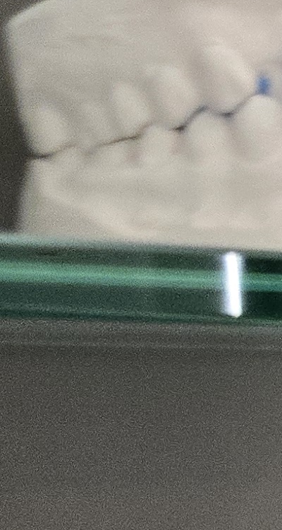 사랑니 주변 잇몸 통증 지금부터가 중요하니까 관련 이미지 23