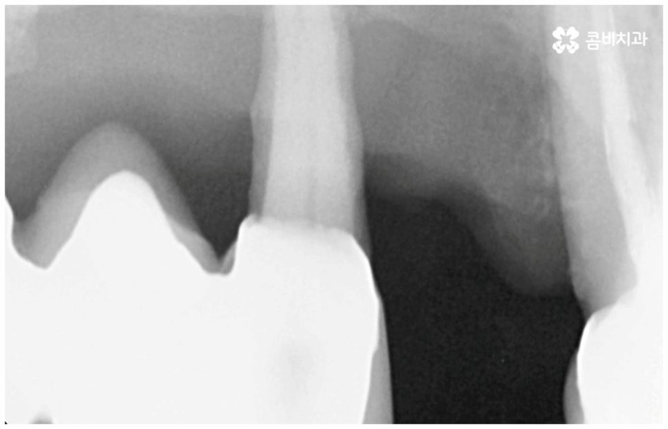 임플란트수명 연장하려면? 관련 이미지 6