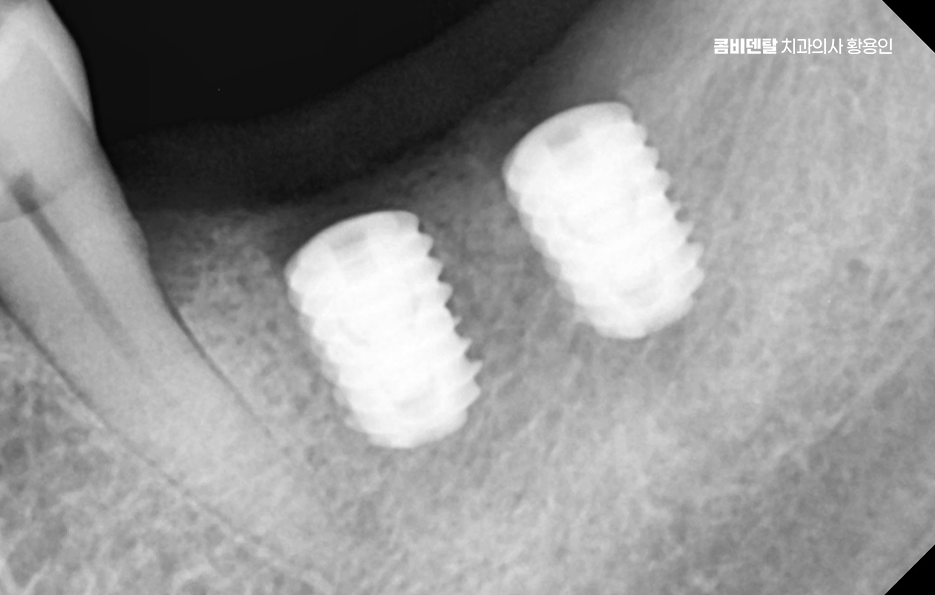 어르신 임플란트 지원 현명하게 활용하려면 관련 이미지 5