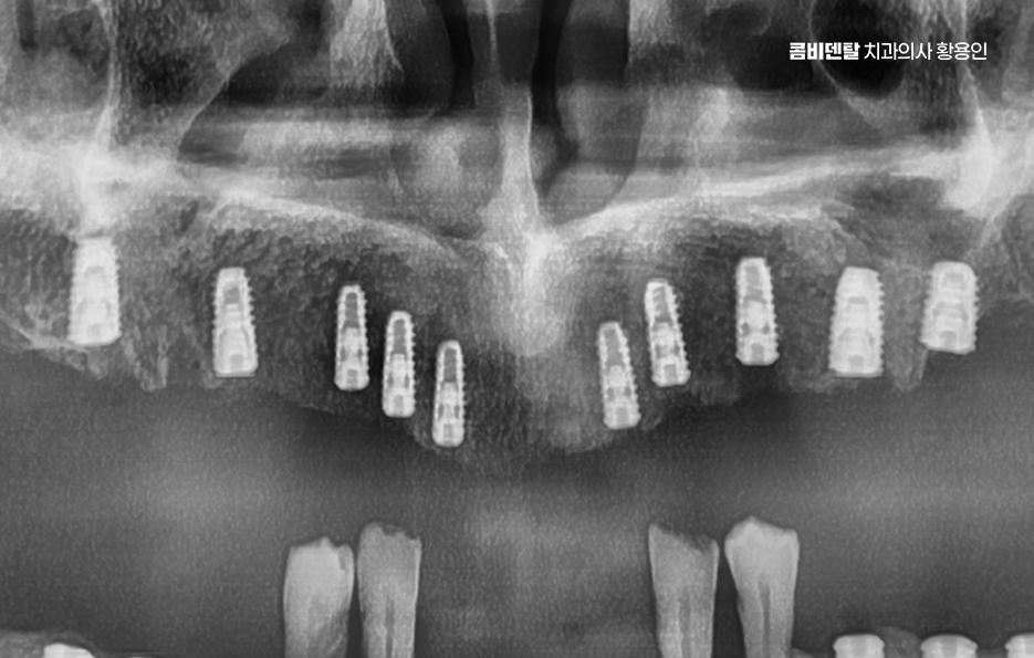 윗니 전체 임플란트 뭐부터 해야할까 관련 이미지 8