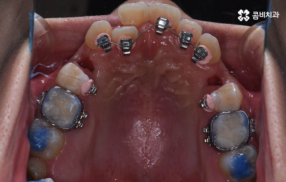 덧니 발치 교정 현명하게 선택하려면 관련 이미지 11