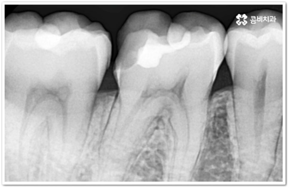 인접면 충치 어떻게 하나요 관련 이미지 1