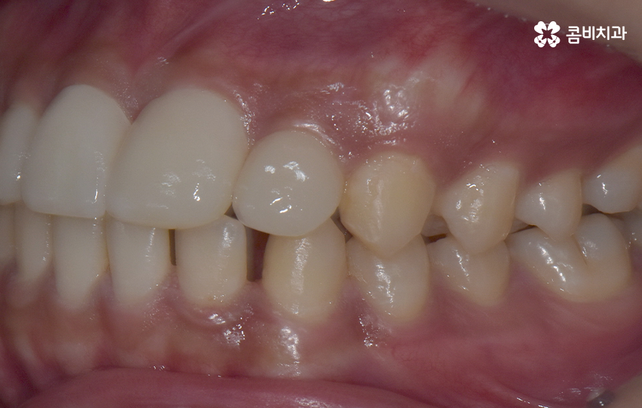 앞니만 교정 과잉치 뽑아서 해결했어요 관련 이미지 13