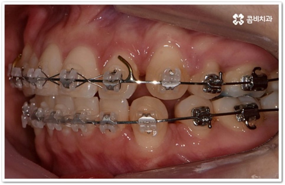 덧니 발치 언제 하나요? 관련 이미지 10