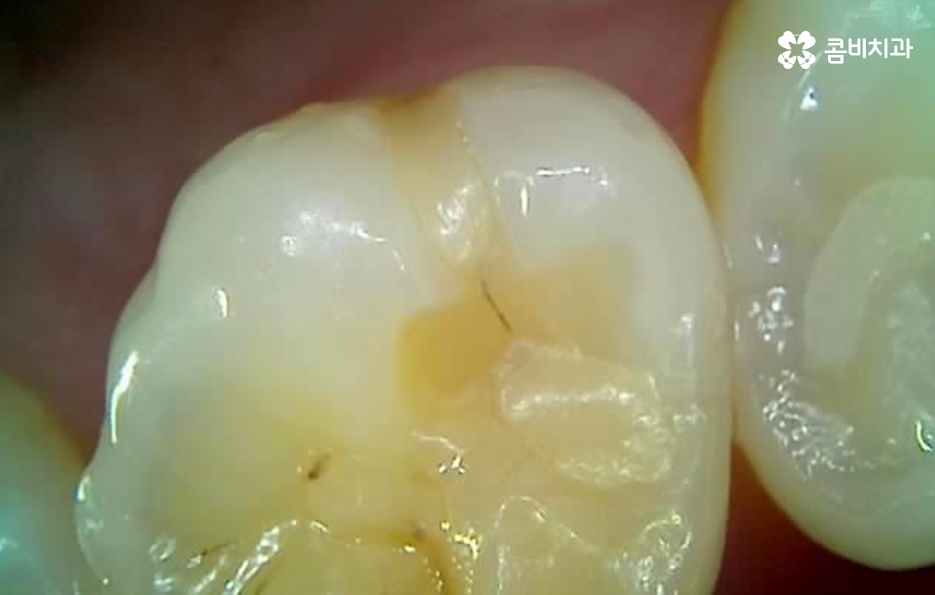 어금니 레진 깨짐 변색 안아파도 이렇게 대처하세요 관련 이미지 12