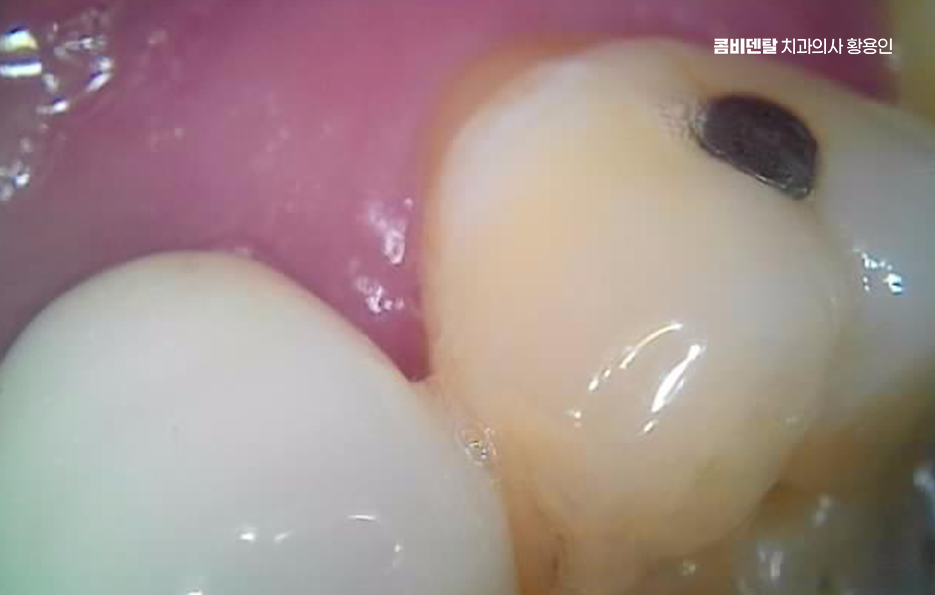 오래된 보철물 아말감 교체 어떠한 케이스일까 관련 이미지 6