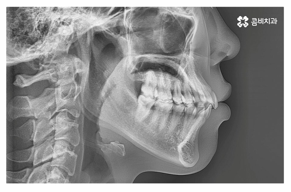 돌출입치아교정 적극적으로 해결하려면 관련 이미지 1