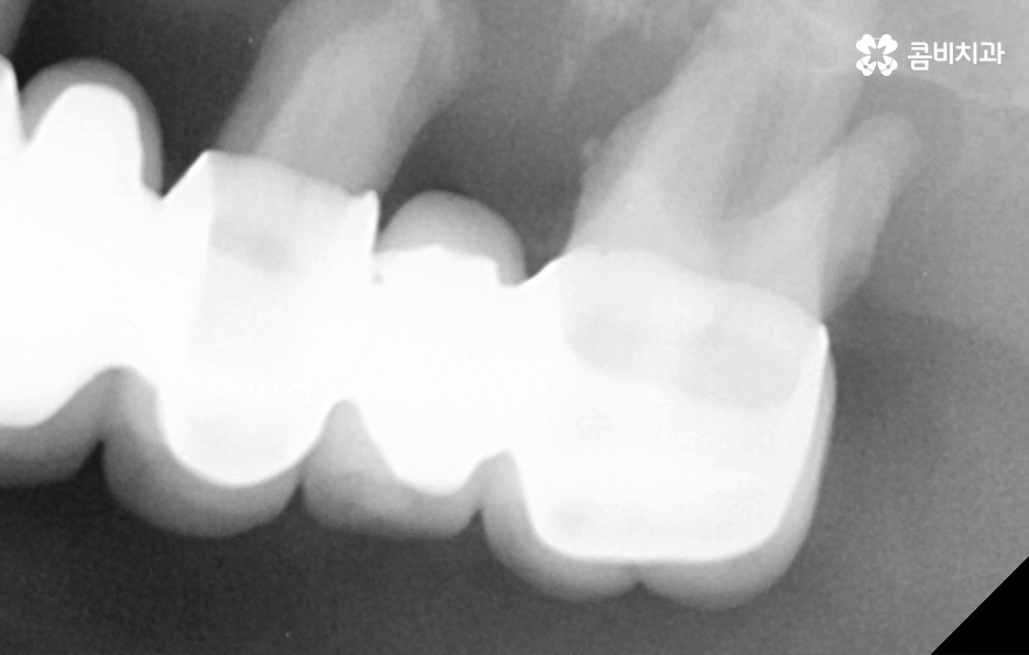 노인임플란트 이것만큼은 기억하세요 관련 이미지 10