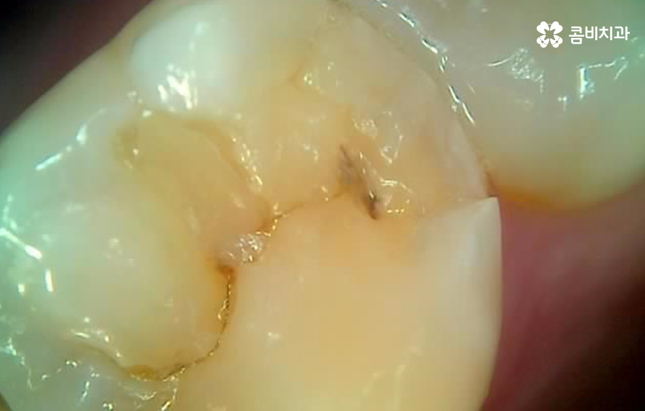 어금니 레진 깨짐 변색 안아파도 이렇게 대처하세요 관련 이미지 6