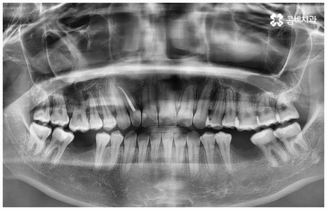 임플란트 종류 어떤게 맞을까요? 관련 이미지 1