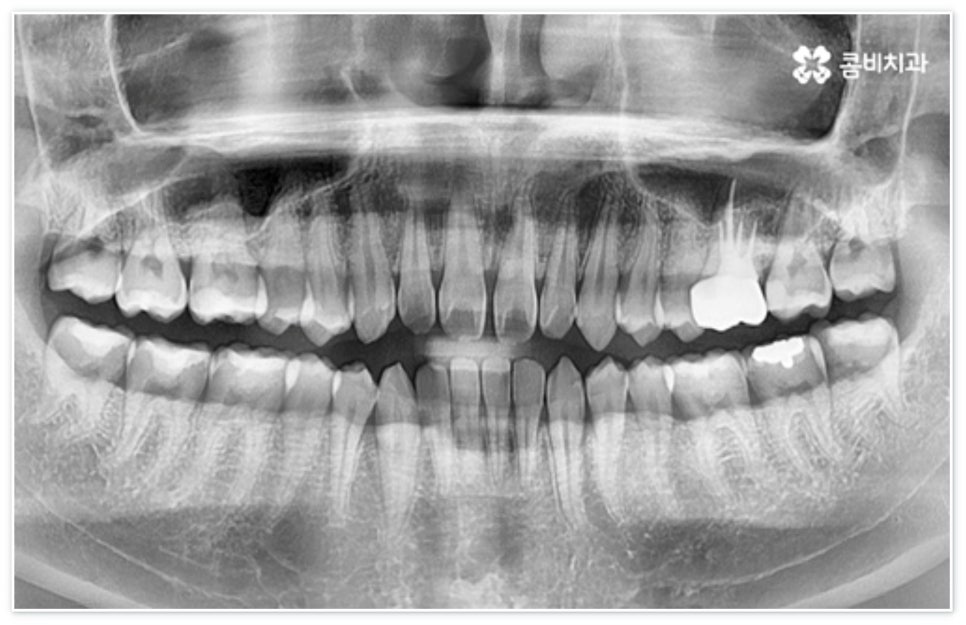 앞니 벌어짐 고치고 싶어요 관련 이미지 2