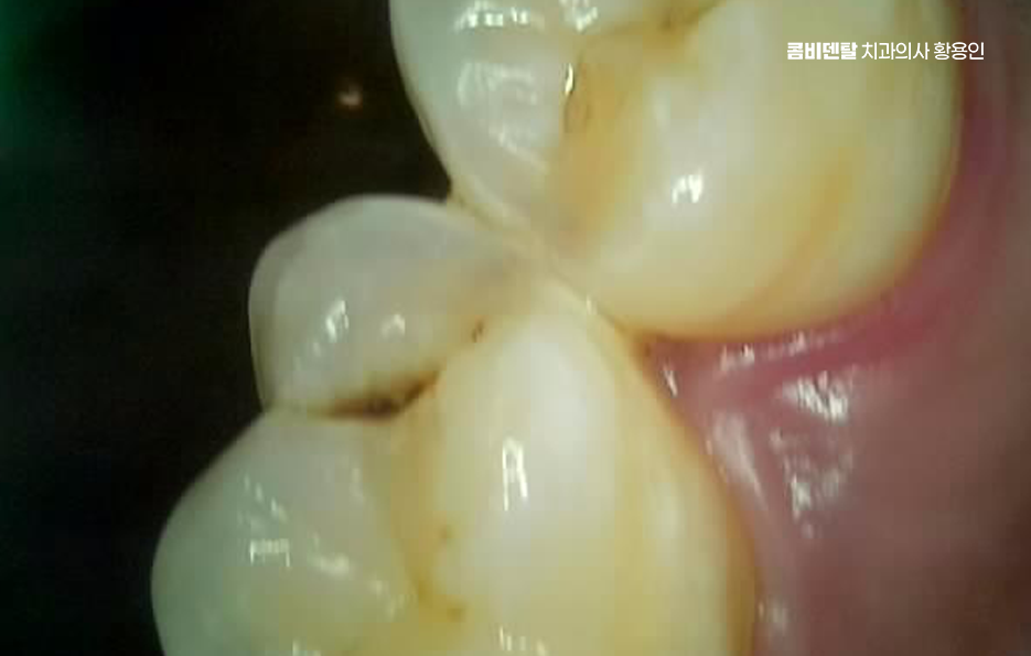 충치 검은점 나타났다면 이렇게 대처해요 관련 이미지 3