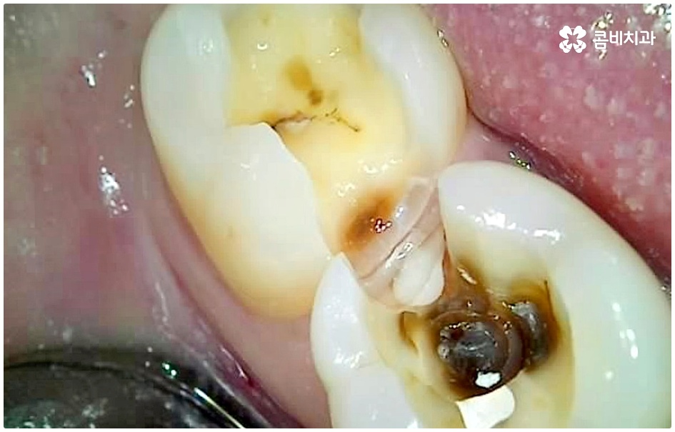 명동치과 평소에 케어하기 관련 이미지 10