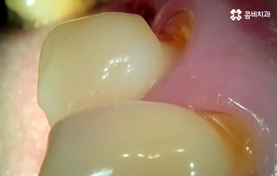 노인임플란트 이때부터 특히 조심하세요 관련 이미지 3