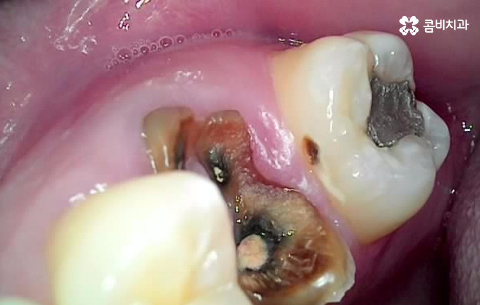충치 신경치료 안하면 후회하는 이유 관련 이미지 6