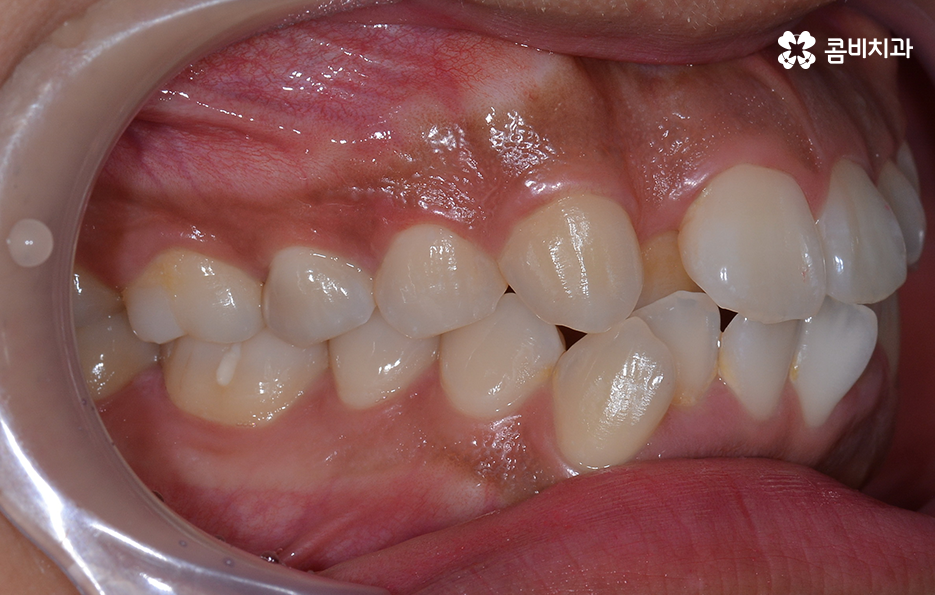 덧니 발치 교정 현명하게 선택하려면 관련 이미지 5