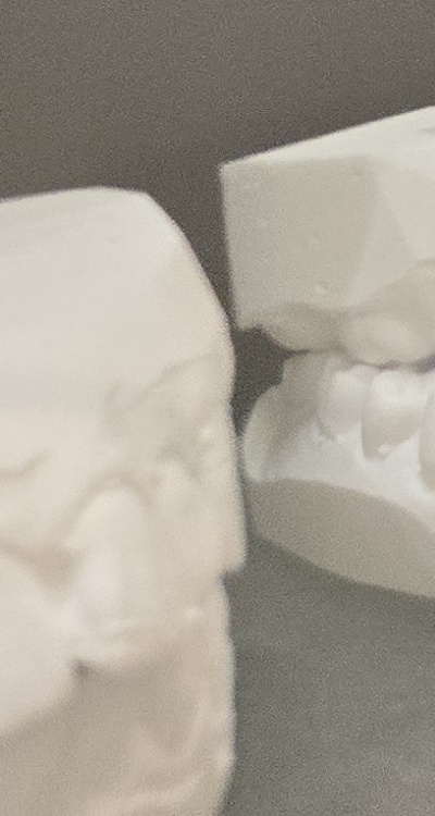 앞니 틀어짐 부분교정 얼마나 걸릴까 관련 이미지 42