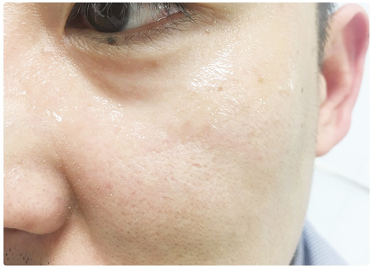 남자주름개선 쉽고 편리하게! 관련 이미지 8