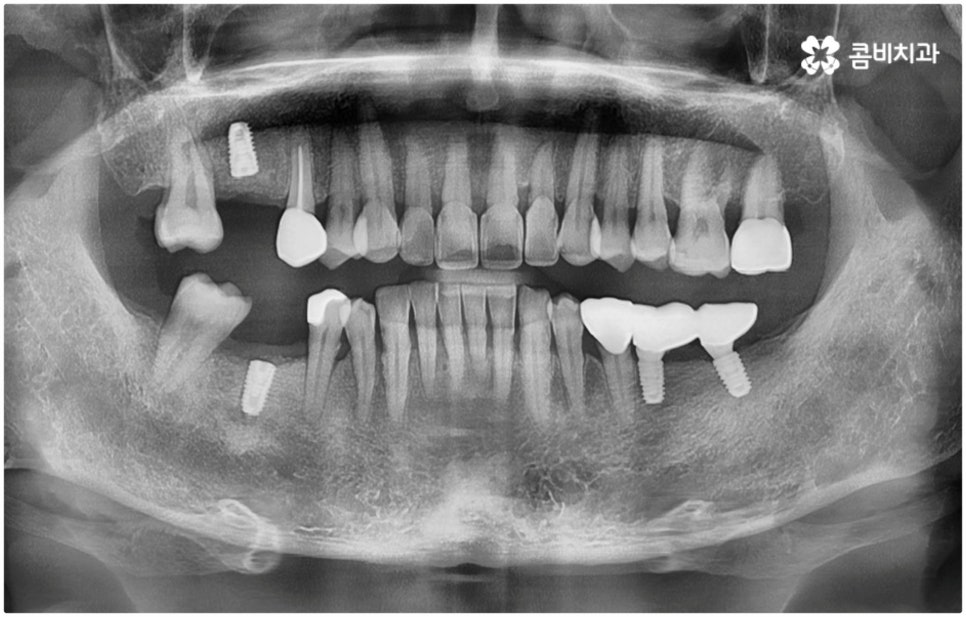 발치후 임플란트 바로 되나요? 관련 이미지 10