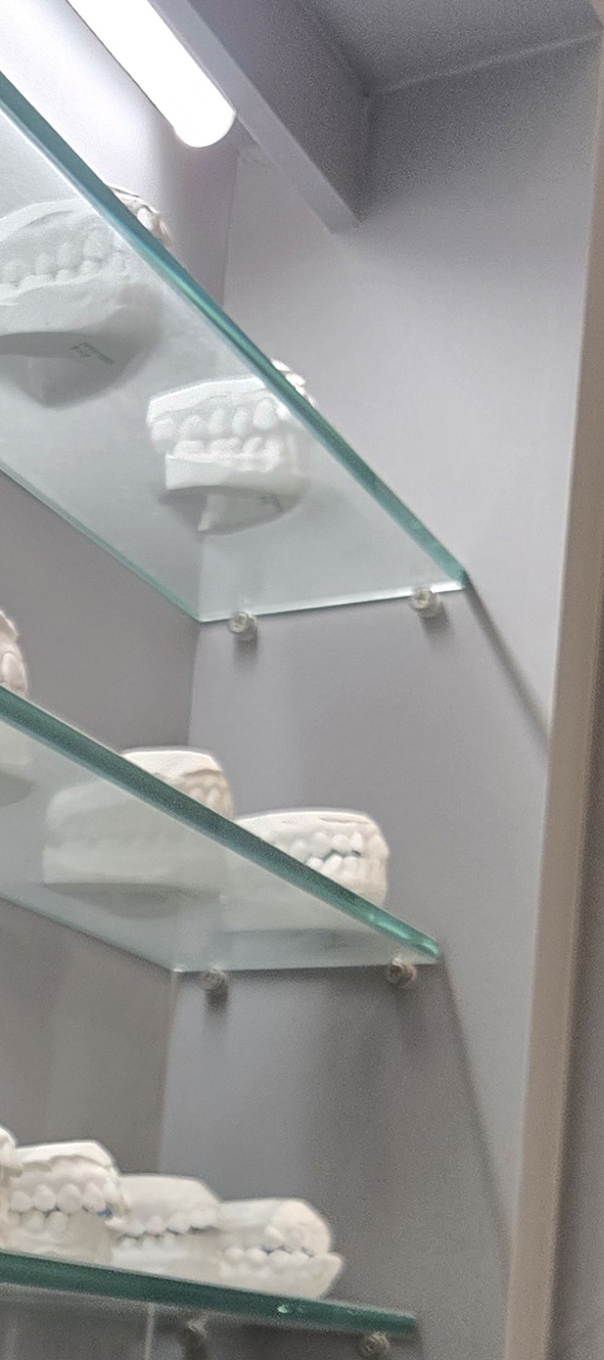 오래된 보철물 아말감 교체 어떠한 케이스일까 관련 이미지 14