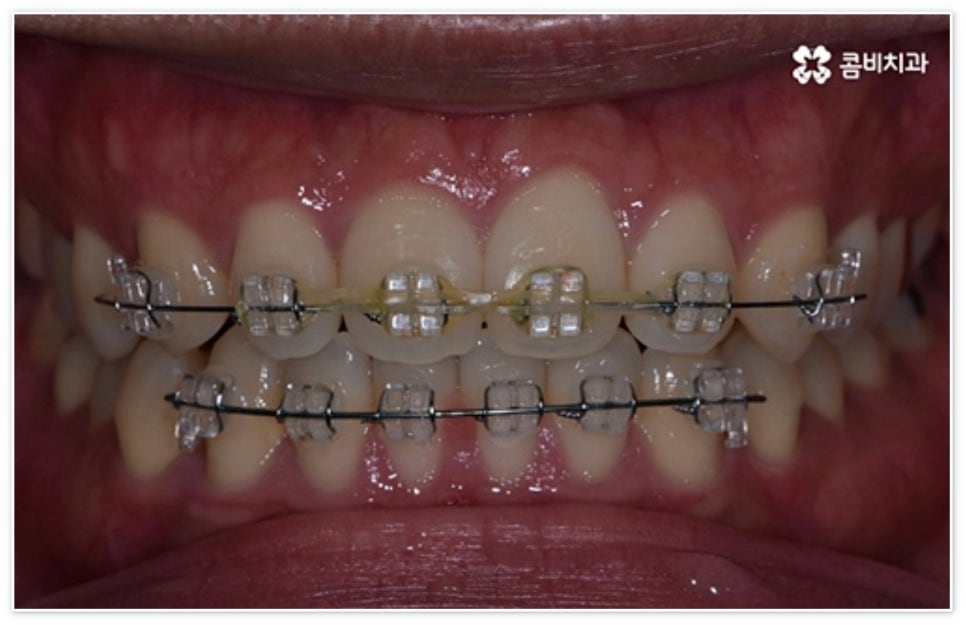 앞니 벌어짐 고치고 싶어요 관련 이미지 8
